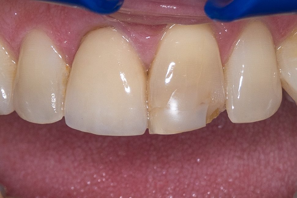 Bonding case 1 - before