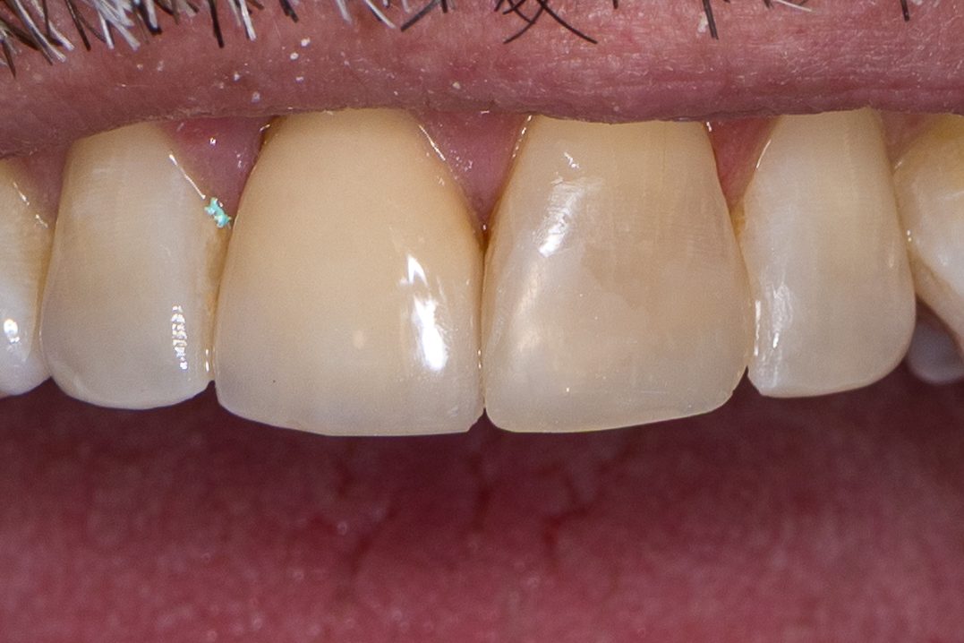 Bonding case 1 - after