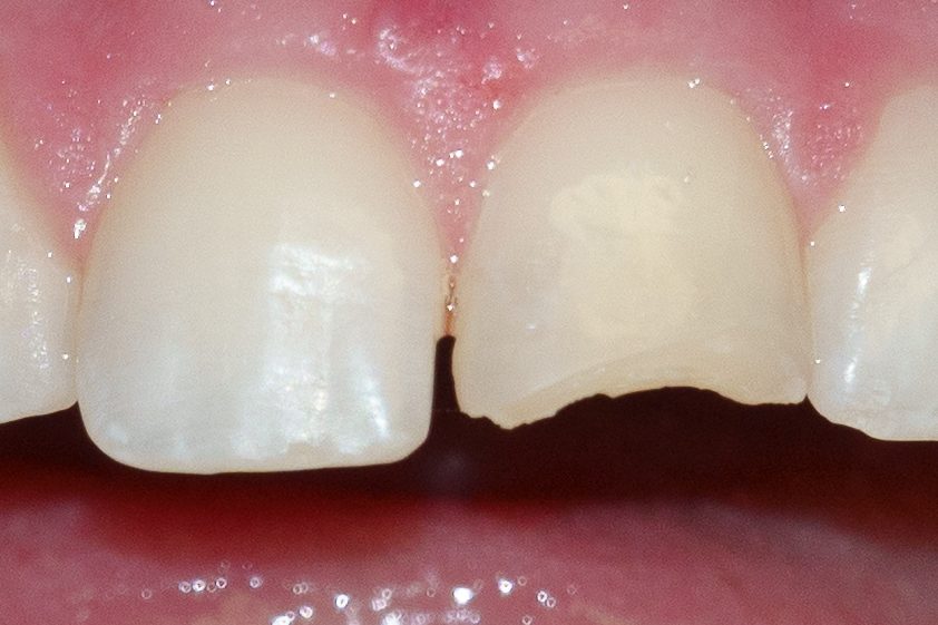 Bonding case 2 - before