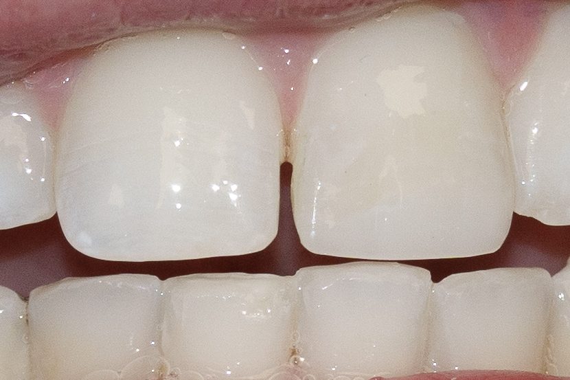 Bonding case 2 - after