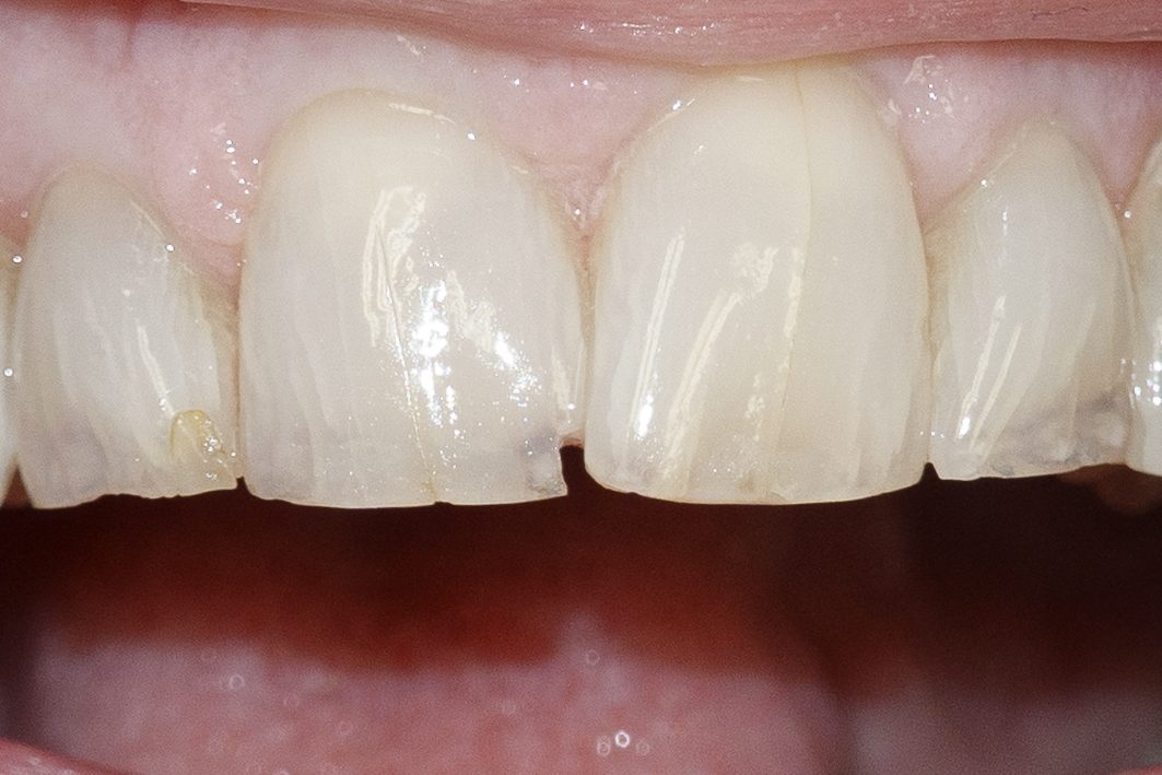 Bonding case 3 - before