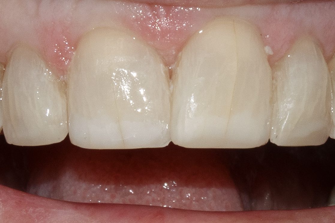 Bonding case 3 - after