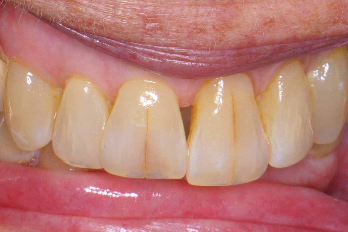 Crown case 1 - before