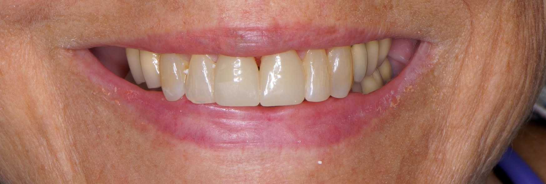 Crown case 1 - after