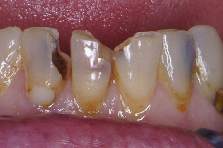 Crown case 2 - before