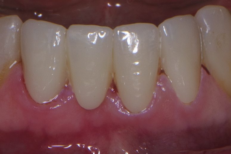 Crown case 2 - after