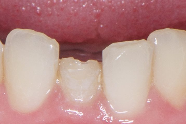 Crown case 3 - before