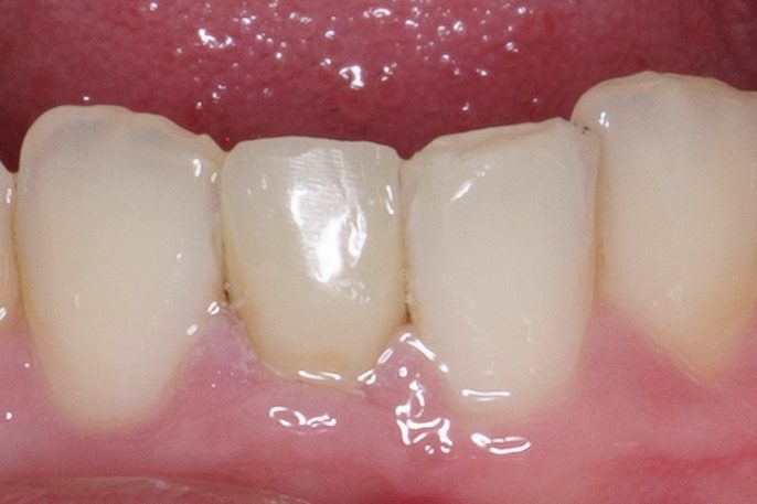 Crown case 3 - after