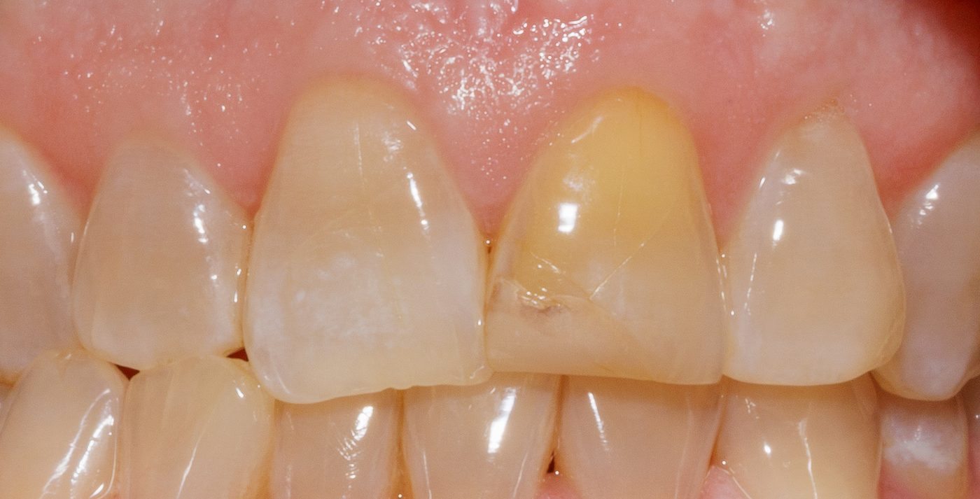 Crown case 4 - before