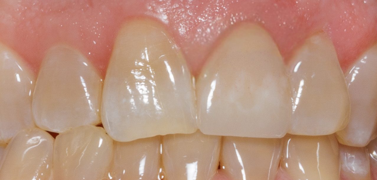 Crown case 4 - after